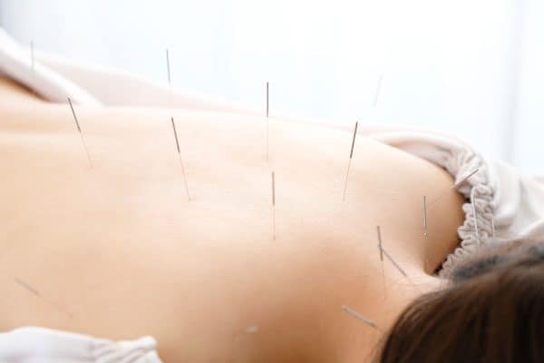 acupuncture treatment promotion