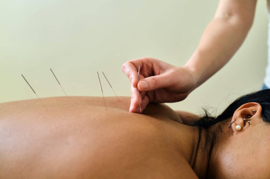 Masseuse putting acupuncture needles in young latin girl's back.