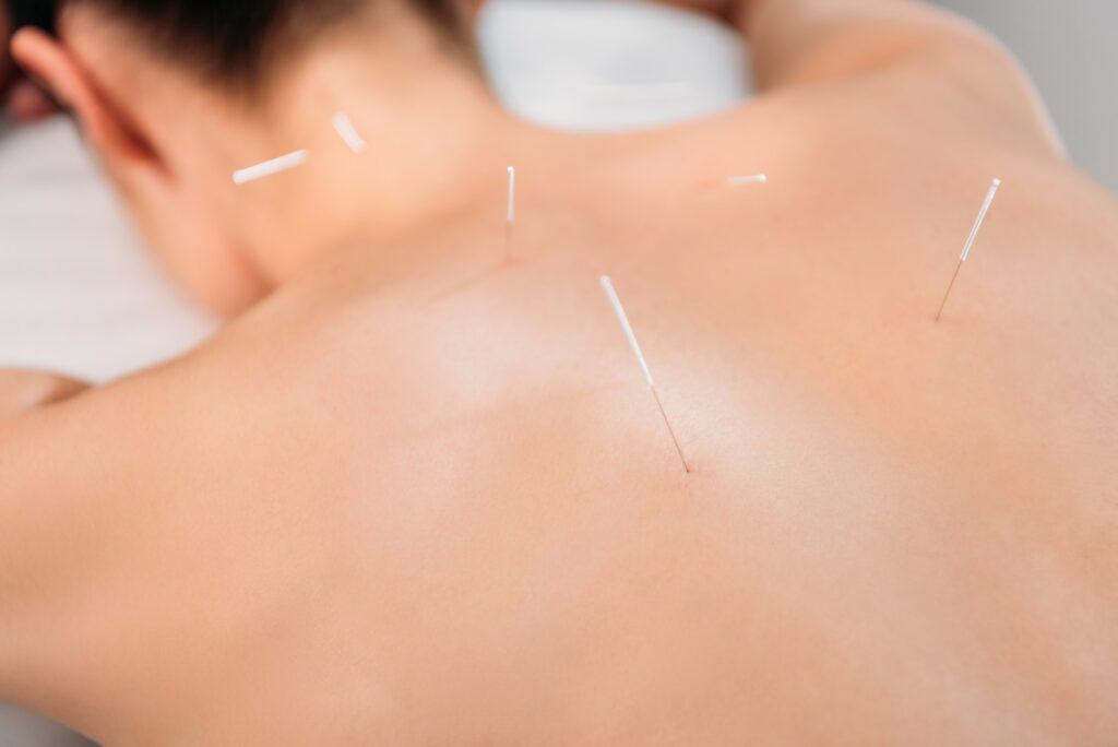 partial view of woman with needles on body having acupuncture therapy in spa salon