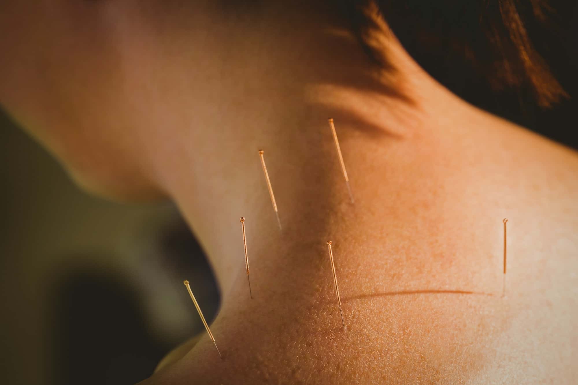 Acupuncture with Electric Stimulation - Acupuncture & Physical Therapy  Specialist