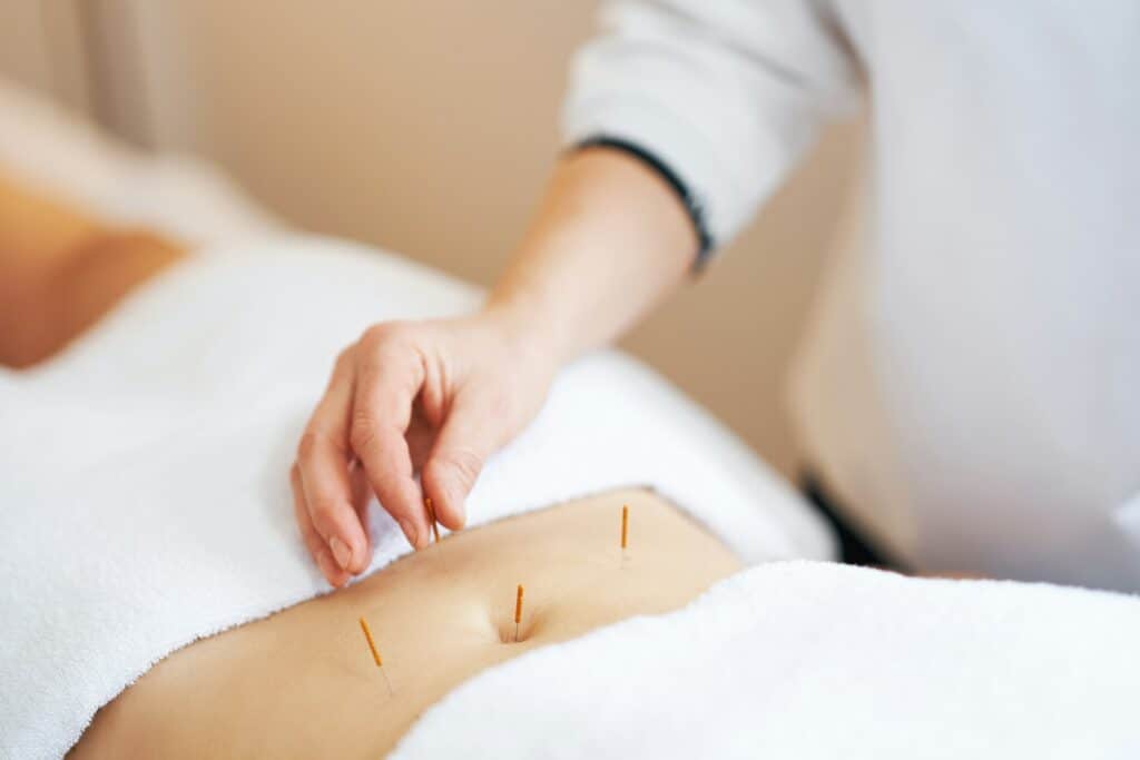 A acupuncture needle therapy in the studio