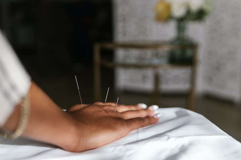 acupuncture on a patient's hand
