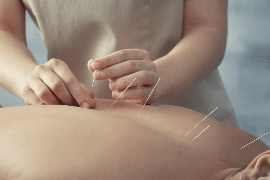 Acupuncture