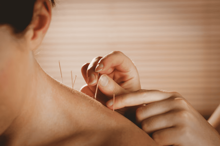 acupuncture on a sitting patient