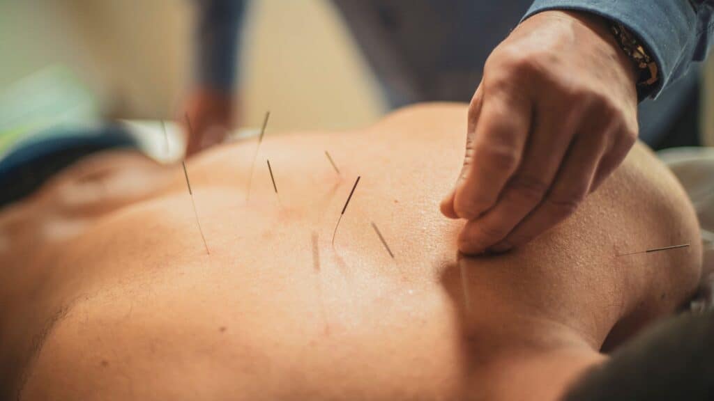 Understanding Acupuncture: Ancient Wisdom in Modern Practice