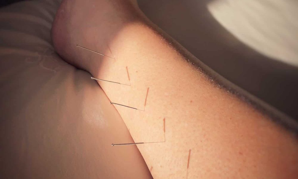 Acupuncture needles in a leg